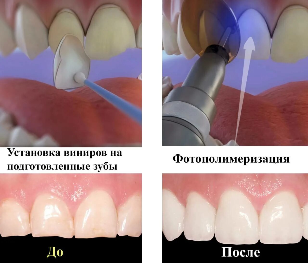 Виниры установка. Виниры спиливание зубов. востановленимезуба вниром.
