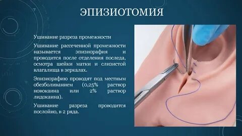 Швы при родах