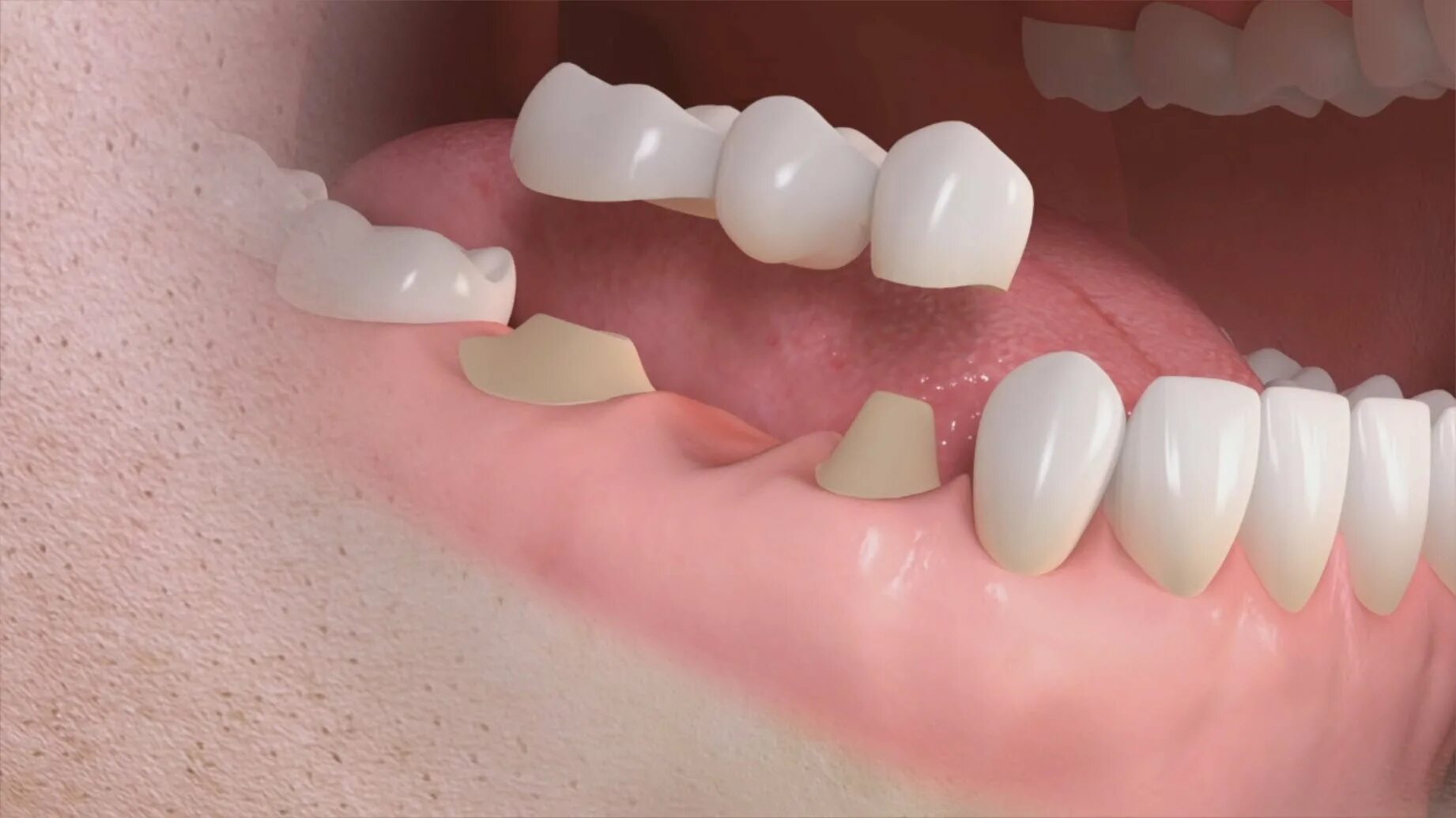 Everything You Need To Know About Dental Bridges Dental bridge, Dental implants 