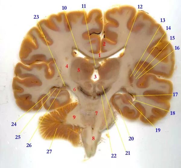 Спайки головного мозга. Таламус фронтальный срез. Таламус на кт анатомия. Поперечный разрез мозга таламус. Фронтальный разрез головного мозга.