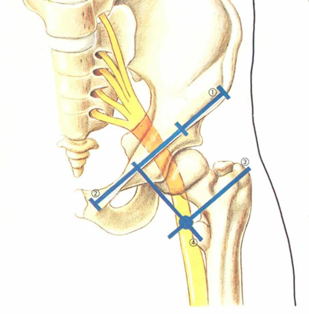 Блокада седалищного нерва техника. Блокада седалищного нерва анестезия. Ориентиры для блокады седалищного нерва. Проводниковая анестезия бедренного нерва.