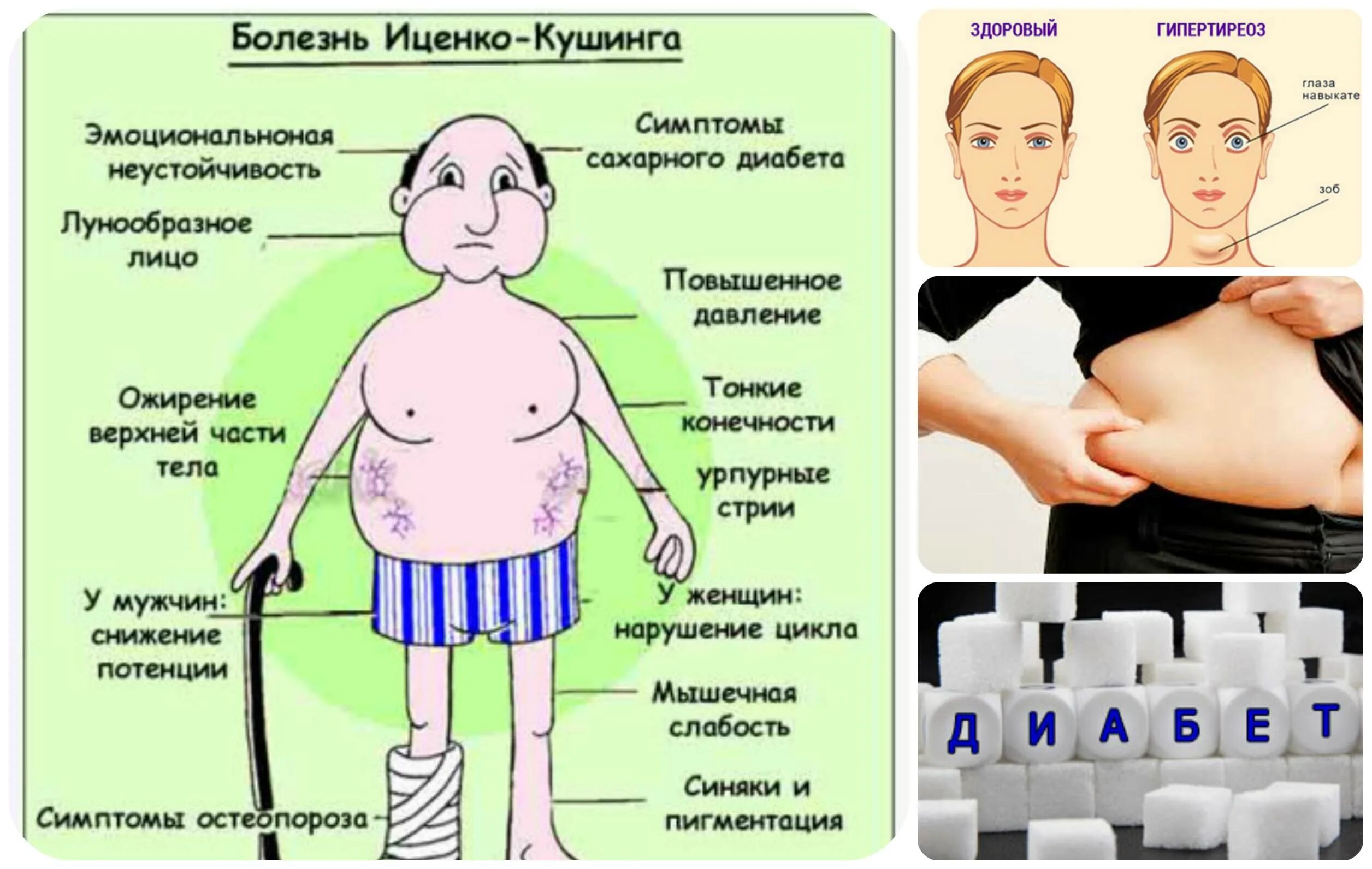 Вызывающий тревогу гормон. Болезнь Иценко Кушинга ожирение. Ожирение при болезни Иценко Кушинга. Тип ожирения при болезни Кушинга. Синдром Иценко -Кушинга надпочечники.