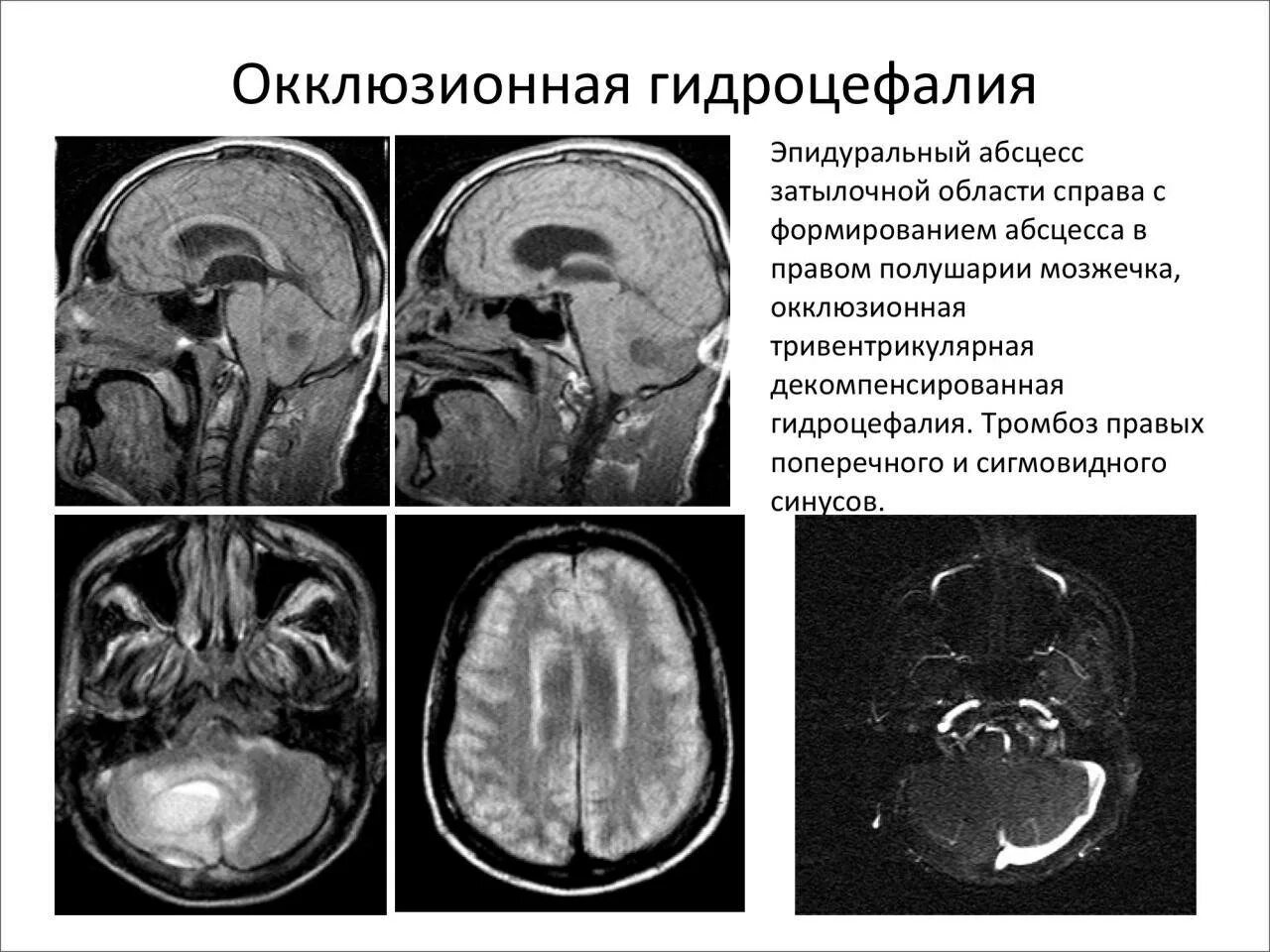 Окклюзионная шунтозависимая гидроцефалия. Арезорбтивная гидроцефалия мрт. Окклюзионная гидроцефалия головного мозга кт. Наружная смешанная заместительная гидроцефалия.