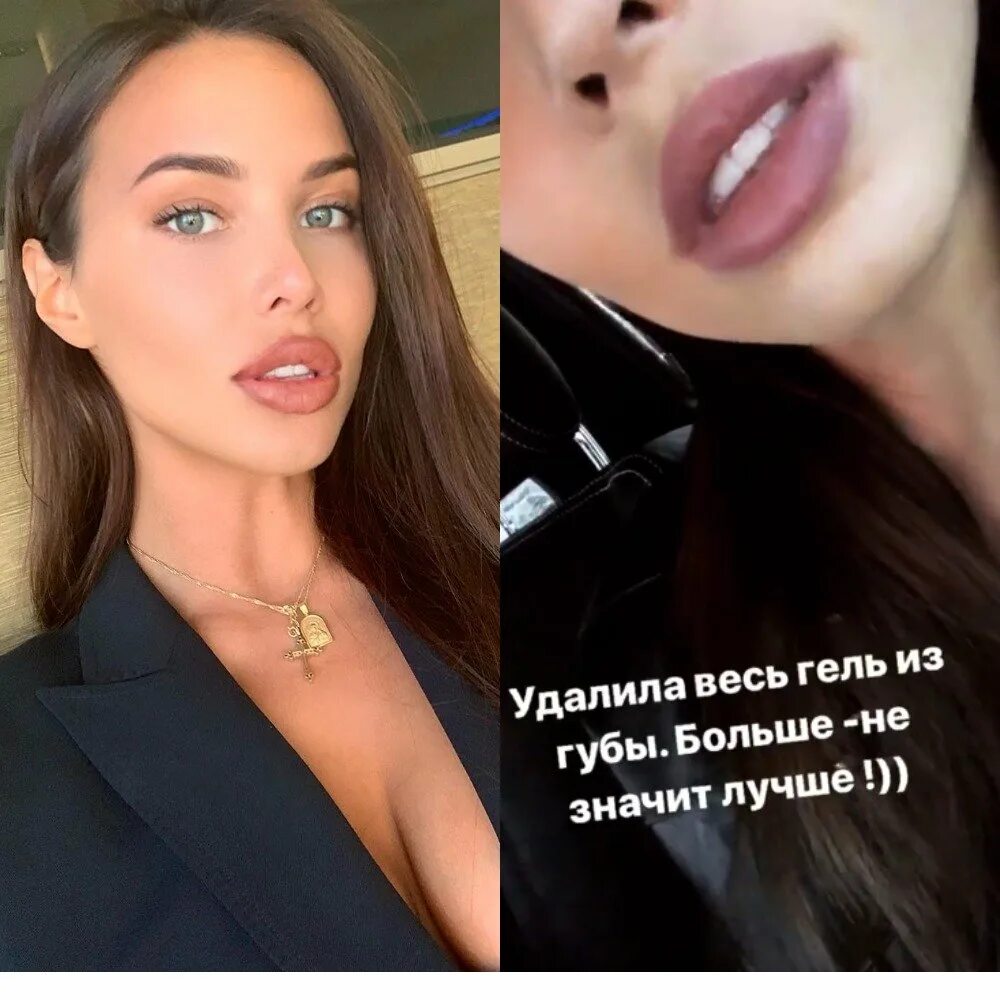 Настя решетова до и после. Настя решетова фото до и после пластики.