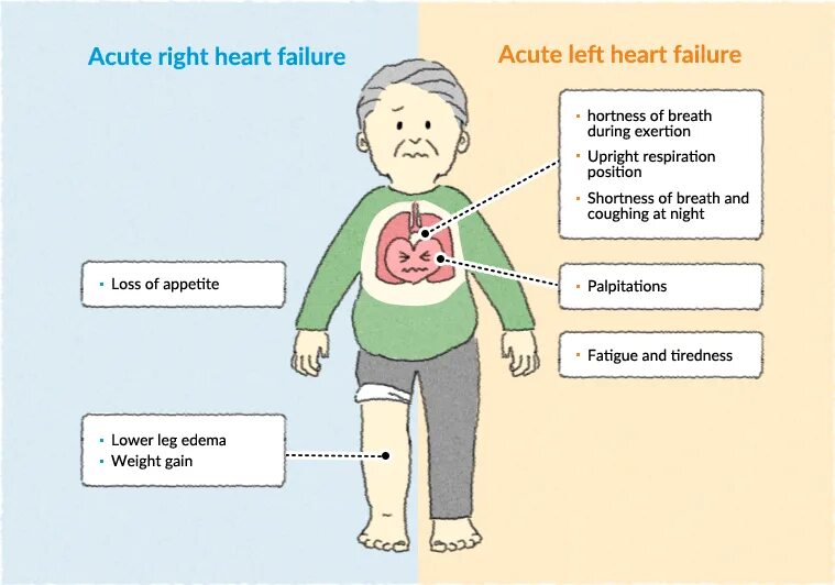 Acute перевод. Right Heart failure. Acute Heart failure Symptoms.