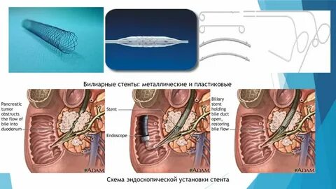 Стентирование желчного протока