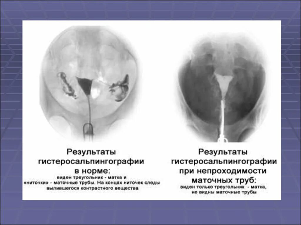 Операция проходимость труб. Гистеросальпингография рентген маточных труб. Непроходимость маточных труб УЗИ. Гистеросальпингография проходимость маточных труб рентген. Снимок непроходимости маточных труб.