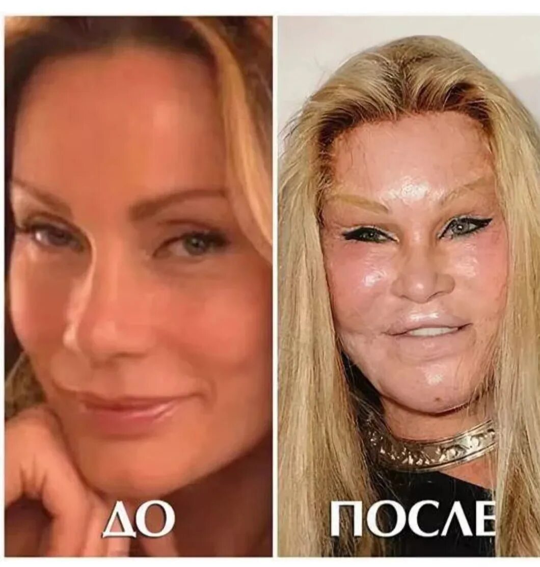 Девочка которой кололи ботокс