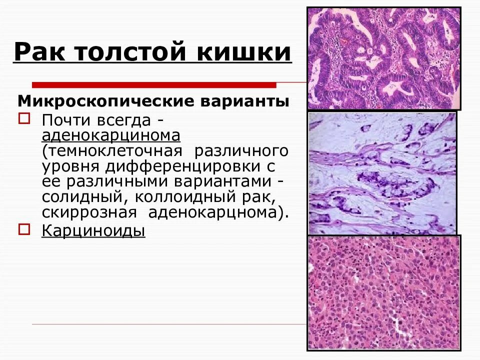 G1 опухоли. Аденокарцинома Толстого кишечника гистология. Аденокарцинома толстой кишки микропрепарат. Аденокарцинома ободочной кишки гистология. Тёмноклеточная аденокарцинома кишечника.