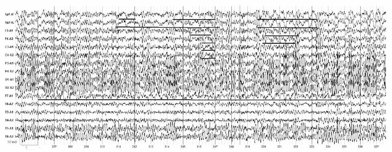 Эпилептиформная активность на ЭЭГ. Спайки на ЭЭГ. Генерализованная эпилептиформная активность на ЭЭГ У ребенка. ЭЭГ билатерально синхронная эпилептиформная активность. Спайк на ээг