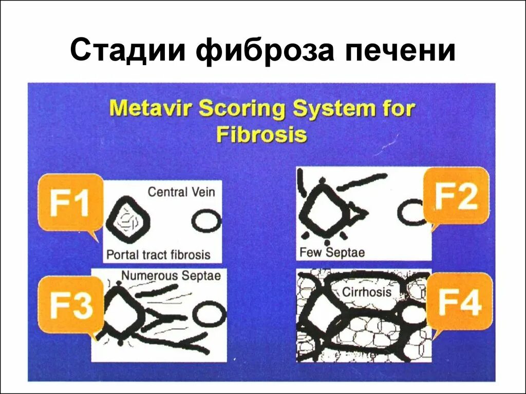 Стадии фиброза. Степени фиброза печени по шкале метавир. Метавир классификация фиброза.