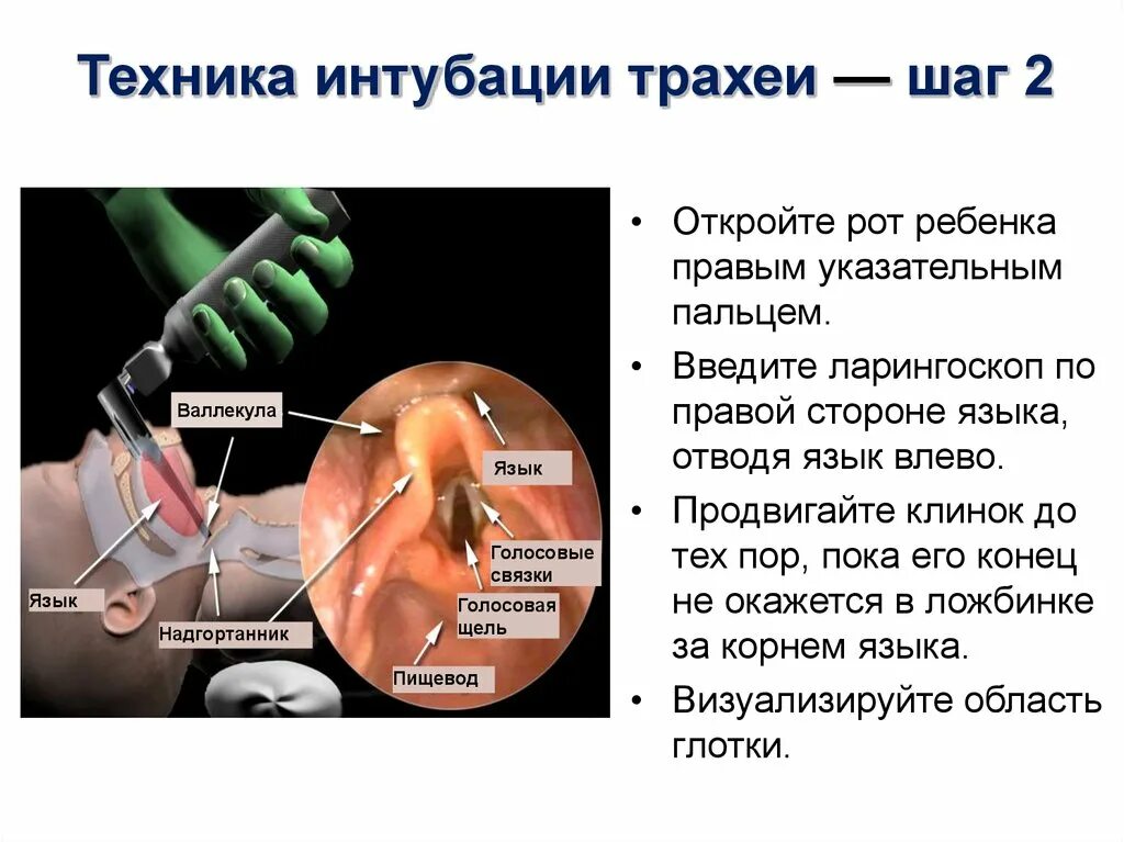 Интубация трахеи методика. Интубация трахеи ларингоскопом. Интубация трахеи эндотрахеальной трубкой. Осложнения трахеи