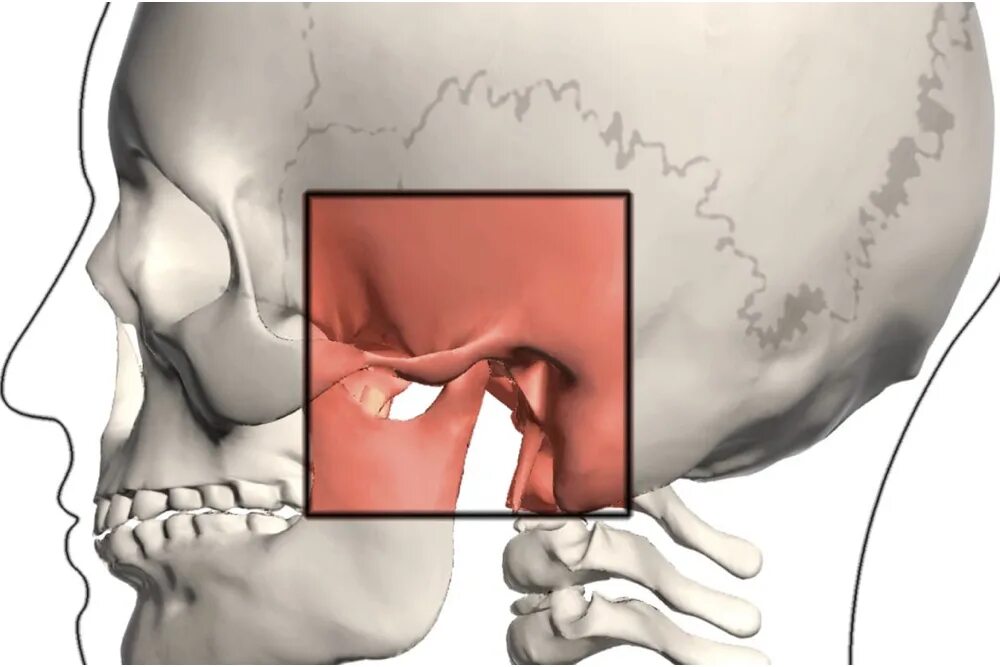 Почему может болеть челюсть. Артрит височно-нижнечелюстного сустава симптомы. Дисфункция ВНЧС симптомы.