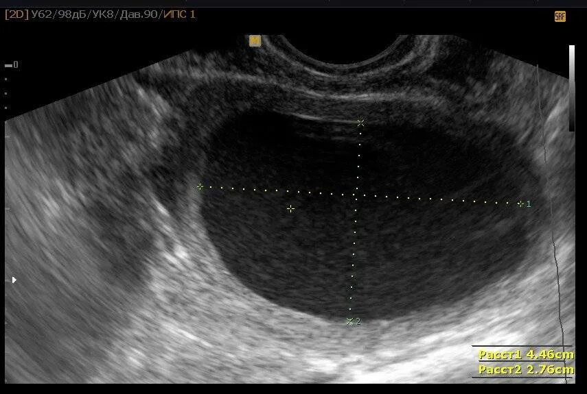 Гематометра на УЗИ. Гематометра на УЗИ после родов. Кальцинаты эндометрия на УЗИ. На узи видно месячные