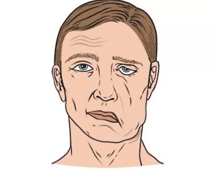 Онемевает правая сторона лица. Инсульт парез лицевого нерва. Неврит лицевого нерва слева. Периферический неврит лицевого нерва.