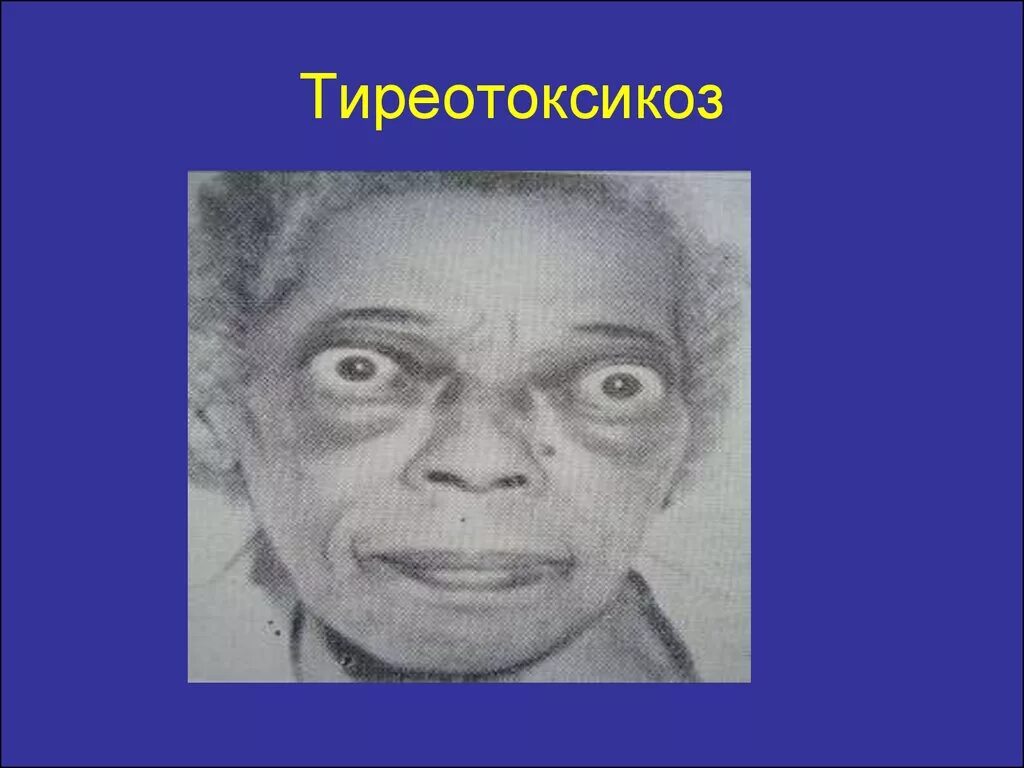 Тиреотоксикоз у взрослых. Акроцианоз при тиреотоксикозе. тиреотоксикоз картинки для презентации. при тиреотоксикозе не отмечаются:.
