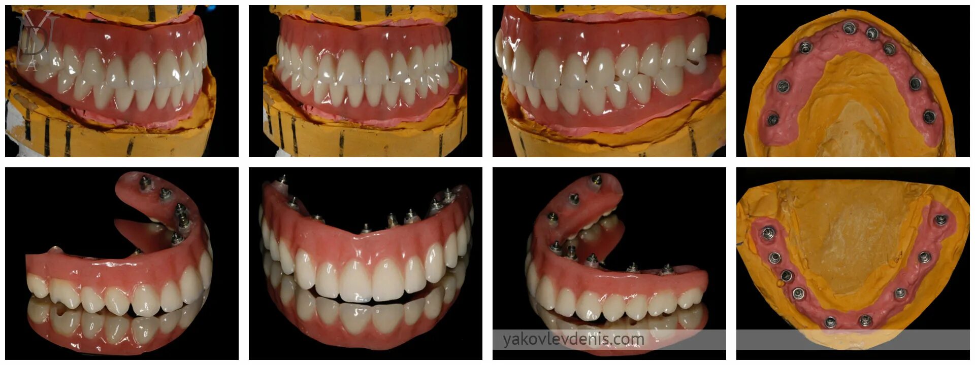 имплантация анапа. имплантация анапа. коронка на импланте рентген. клиника бондаренко анапа.