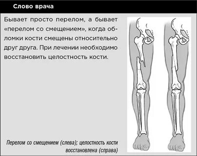 Закрытый перелом кости без смещения мкб