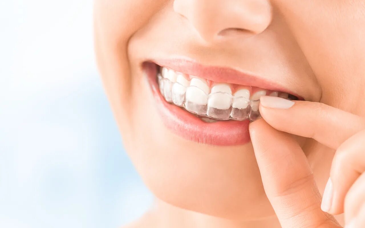 Invisalign