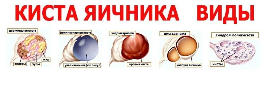 Можно ли при кисте заниматься интимной