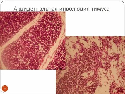 Инволюция тимуса начинается