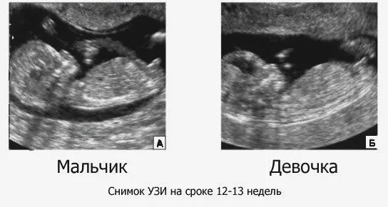 УЗИ 13 недель беременности мальчик. УЗИ 13 недель беременности пол ребенка мальчика. УЗИ 12 недель беременности пол ребенка девочка. Пол плода на УЗИ В 12 недель беременности. Шевеления на 12 неделе