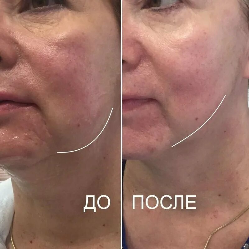 Смас лифтинг цены в Москве: 109 косметологов со средним рейтингом 4.9 с отзывами