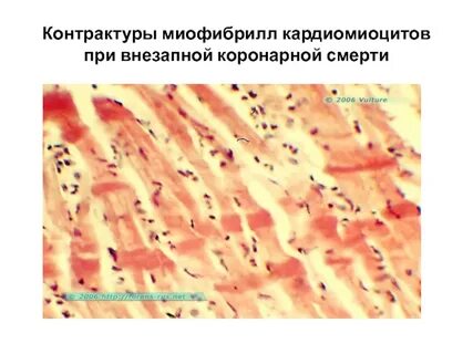 Внезапная коронарная