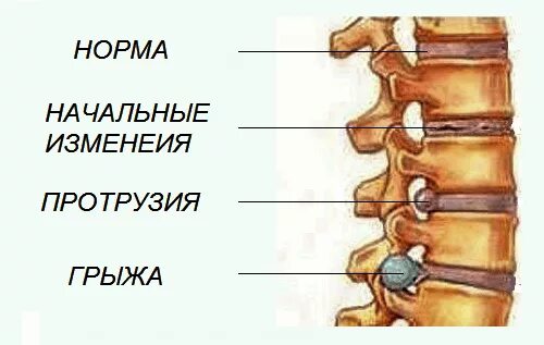 Грыжа поясничного отдела лечение у мужчин симптомы. Грыжа позвоночника. Грыжа позвоночника поясничного отдела. Грыжа позвоночника симптомы.