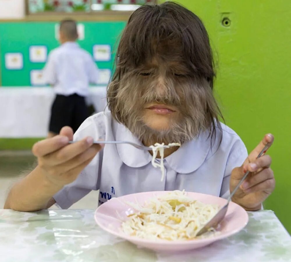 волосы на лице болезнь