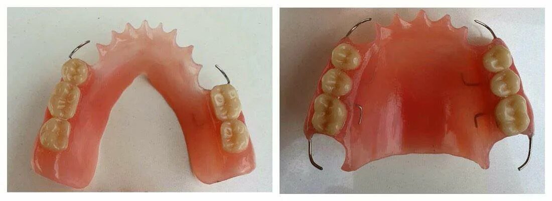 Границы пластиночного протеза. Частичный съемный пластиночный протез на верхнюю челюсть. Частичный съемный протез на нижнюю челюсть. Частичные съемные зубные протезы. Зубной протез на верхнюю челюсть.