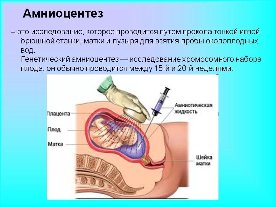 Исследование околоплодных вод амниоцентез. Амниоцентез сущность метода. Амниоцентез метод исследования. Инвазивная диагностика амниоцентез. Инвазивный тест при беременности