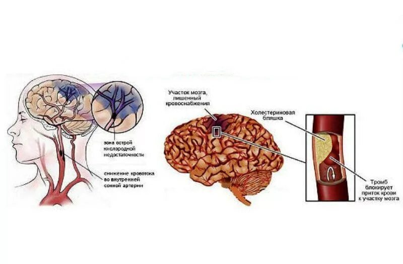 Инфаркт мозга причины. Ишемический инфаркт головного мозга причины. Ишемический инфаркт ствола мозга. Ишемический инсульт и инфаркт. Ишемический инсульт (инфаркт мозга).