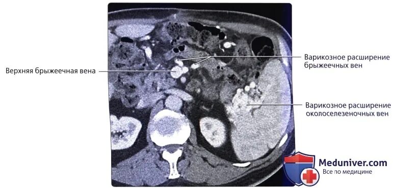 Верхнебрыжеечная Вена кт. Контрастирование селезенки на кт. Расширение селезеночной вены