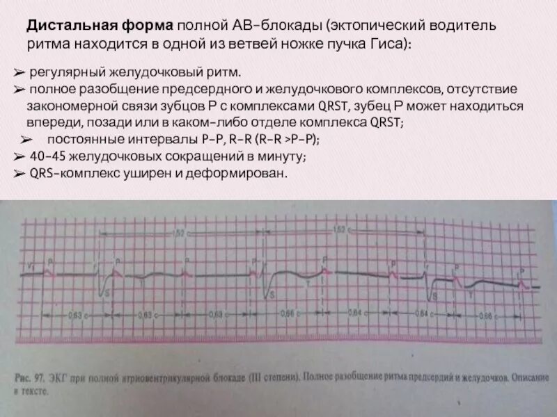 Предсердная блокада. Дистальная АВ блокада 2 степени. Полная АВ блокада дистальный Тип. Дистальная форма полной АВ блокады. Желудочковый ритм при АВ блокаде.