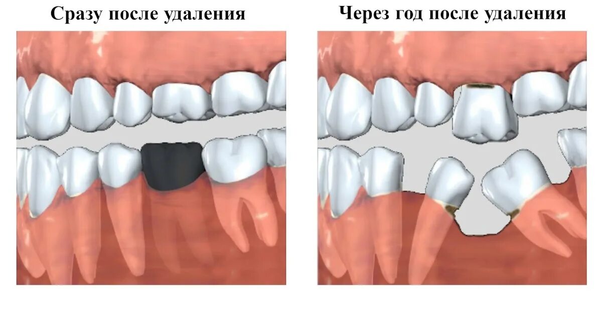 Можно ли поставить зуб после удаления. Феномен попова -годона зубов. феномен попова -годона ортопедическая стоматология.