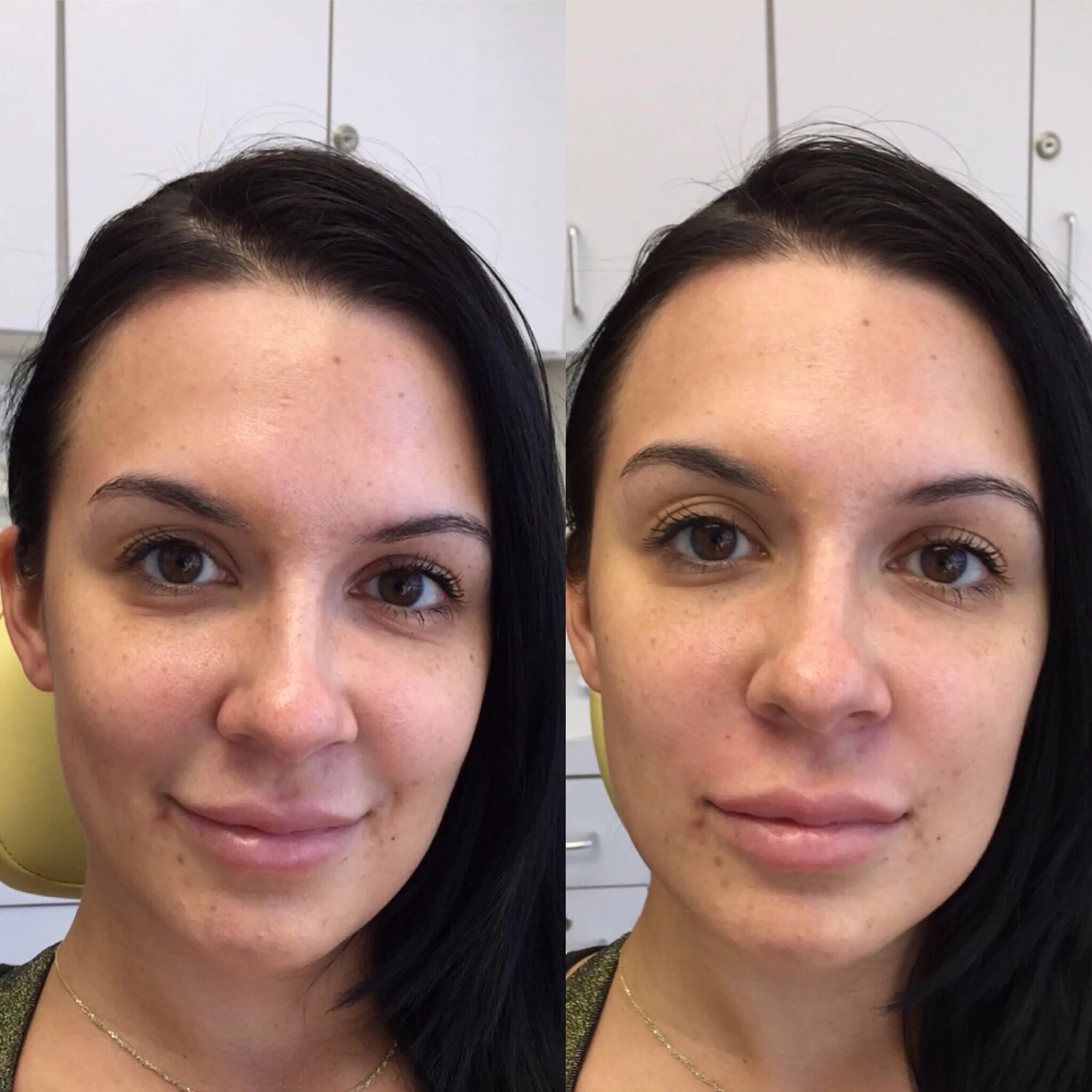 Уколы худое лицо до и после отзывы Pin on Cosmetic