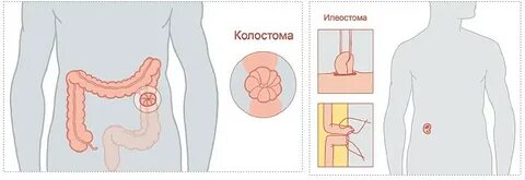 Выведен кишечник