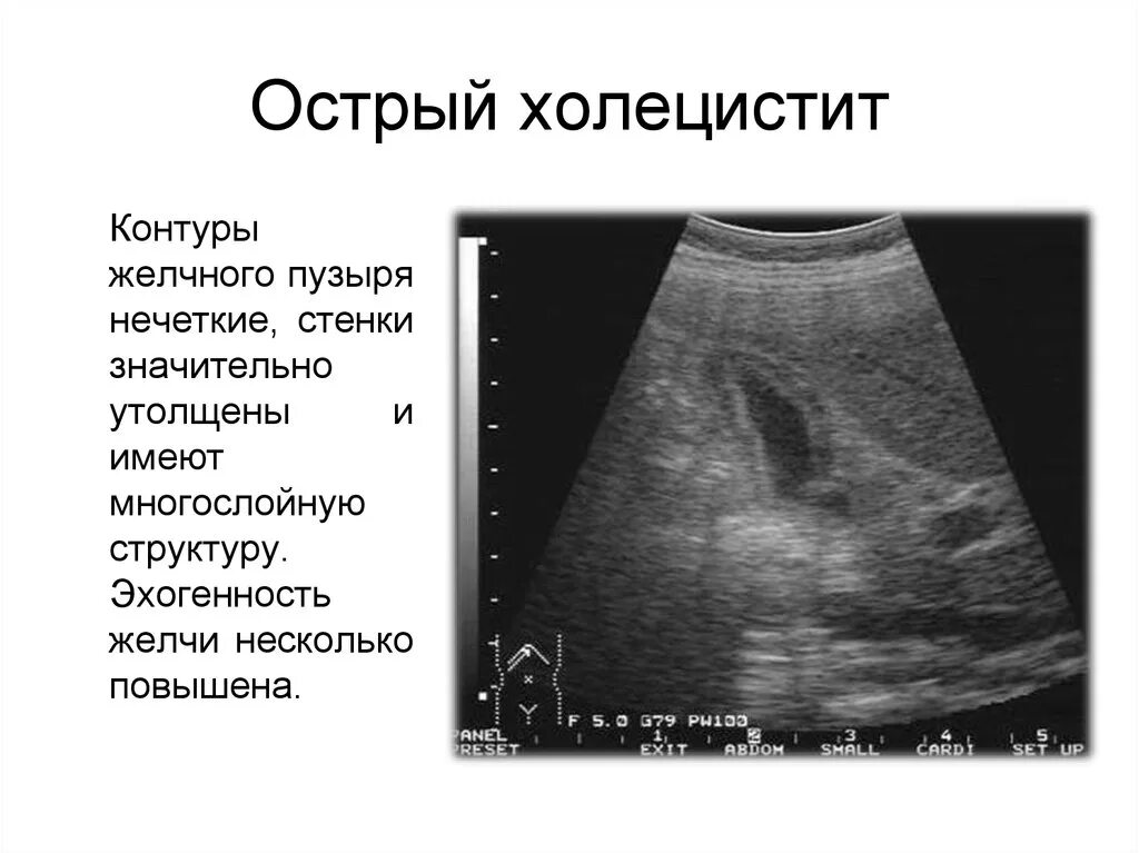 Сонограмма желчного пузыря. УЗИ критерии острого холецистита. УЗИ желчного пузыря хронический холецистит. УЗИ признаки острого холецистита. Эхо признаки желчного пузыря