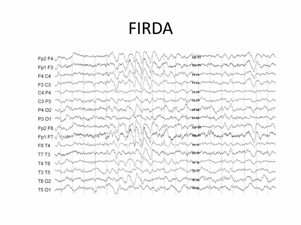 Ээг 2 часа. Firda на ЭЭГ. Вертекс потенциалы на ЭЭГ. Oirda на ЭЭГ У ребенка. Firda на ЭЭГ У взрослых.