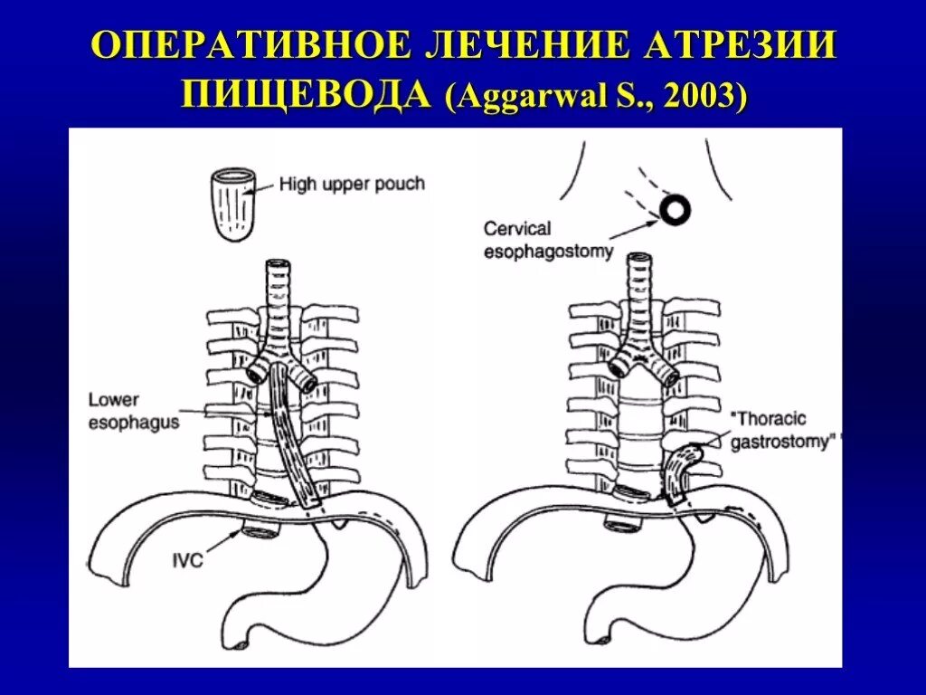 Атрезия пищевода. Атрезия пищевода хирургия операции. атрезия пищевода у детей операция. оперативное лечение атрезии пищевода. атрезия пищевода клиника.