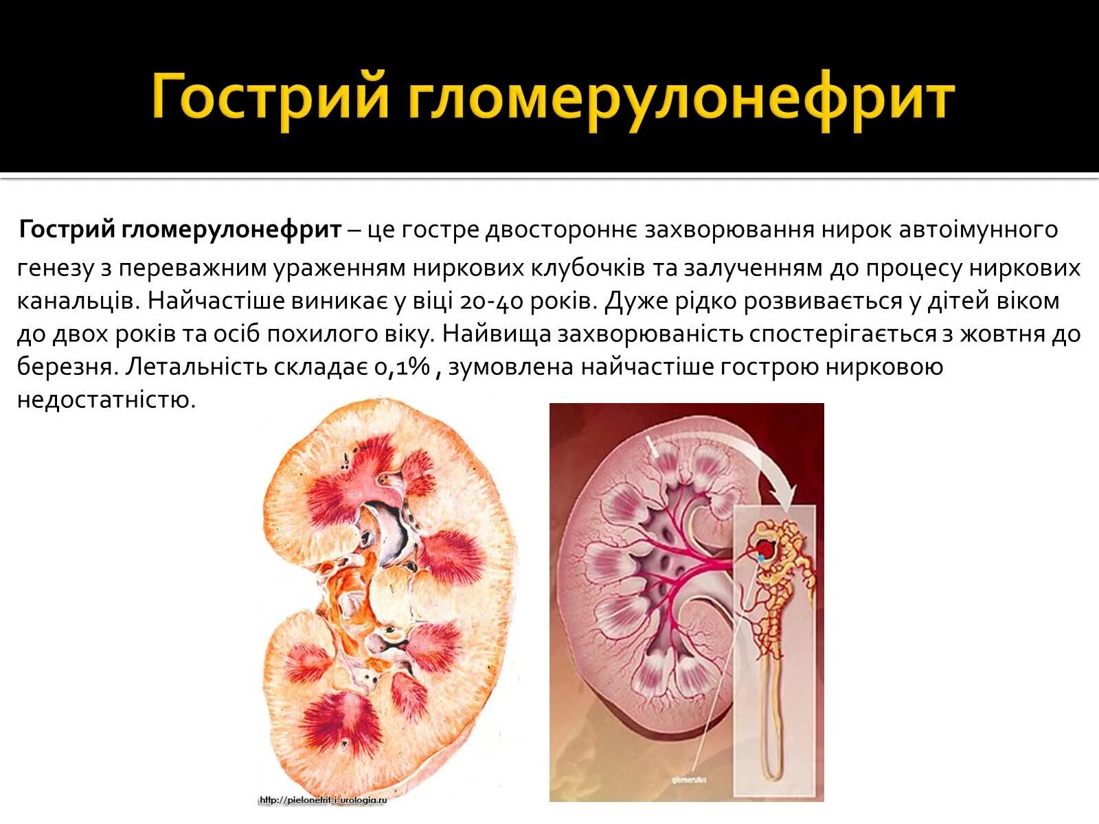 Острый гломерулонефрит ад. Тест по теме хронический гломерулонефрит. острый и хронический гломерулонефрит.
