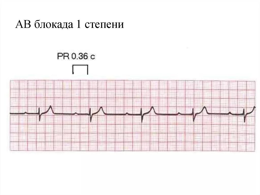 Блокада на первом. ЭКГ при АВ блокаде 1 степени. АВ блокада 1 степени на ЭКГ. Атриовентрикулярная блокада 1 степени на ЭКГ. АВ блокада степени на ЭКГ.