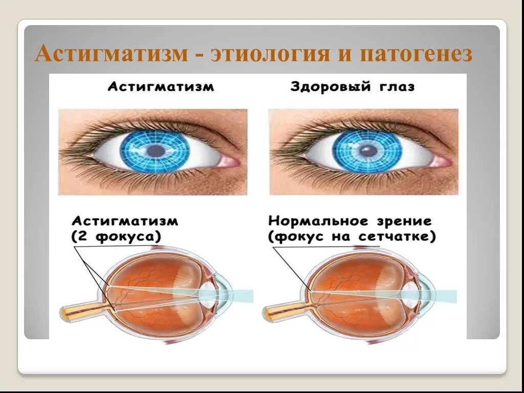 Миопический роговичный астигматизм. Сложный миопический астигматизм ou. Миопия гиперметропия астигматизм. Сложный миопический астигматизм левого глаза у ребенка. Сложный гиперметропический астигматизм глаз