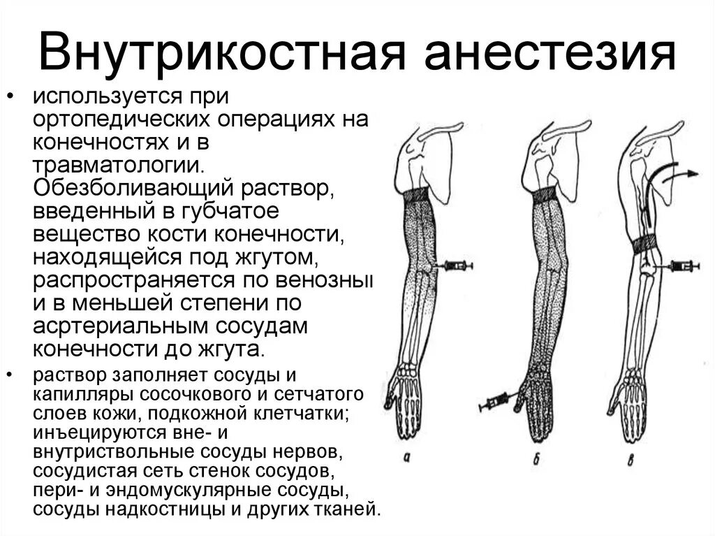 Внутрикостная блокада. Внутривенная и внутрикостная анестезия. Внутрикостная анестезия в стоматологии методика. Внутрикостная регионарная анестезия. Внутрикостная анестезия на верхней конечности.