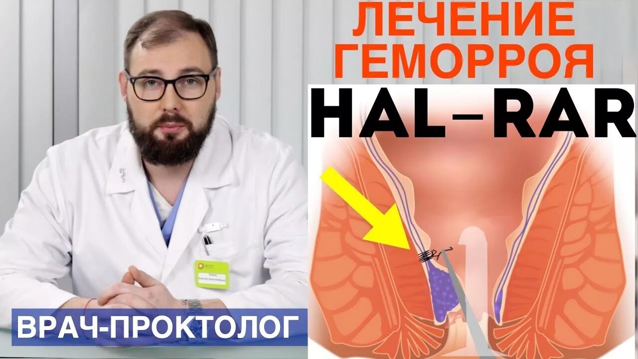 Врач при геморрое у мужчин. Операция геморрой хал рар. Hal-rar дезартеризация геморроидальных узлов. Дезартеризация внутренних геморроидальных узлов. Операция хал рар при геморрое.