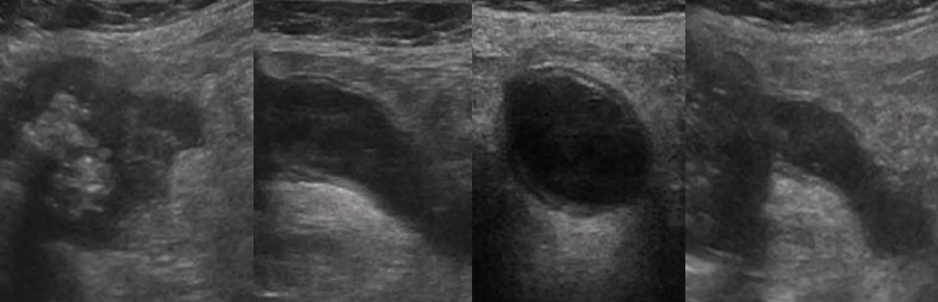 Эмпиема червеобразного отростка УЗИ. Мукоцеле червеобразного отростка УЗИ. Аппендикулярный отросток на УЗИ. На узи видно воспаление