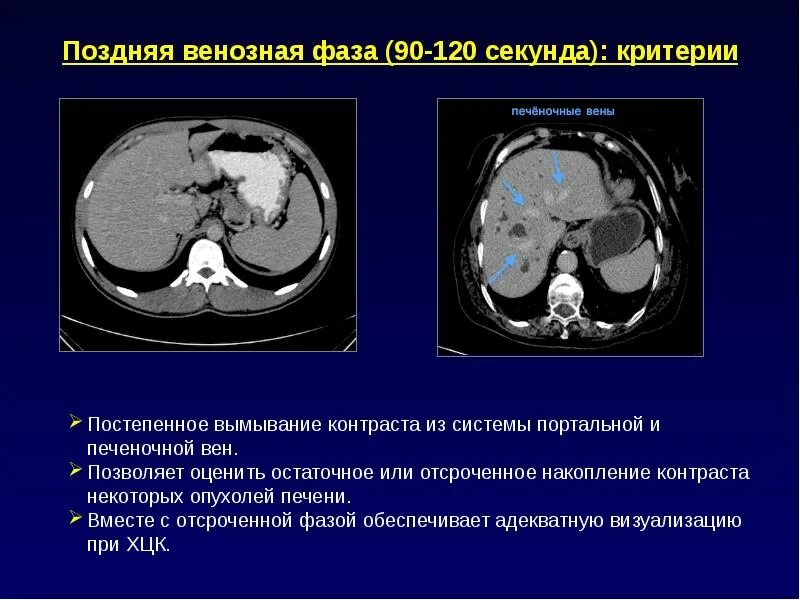 Кт мвс без контрастирования. Фронтальная поверхность на кт. Злокачественная опухоль головного мозга на кт. Портальная фаза контрастирования при кт. Гиподенсный очаг печени кт.