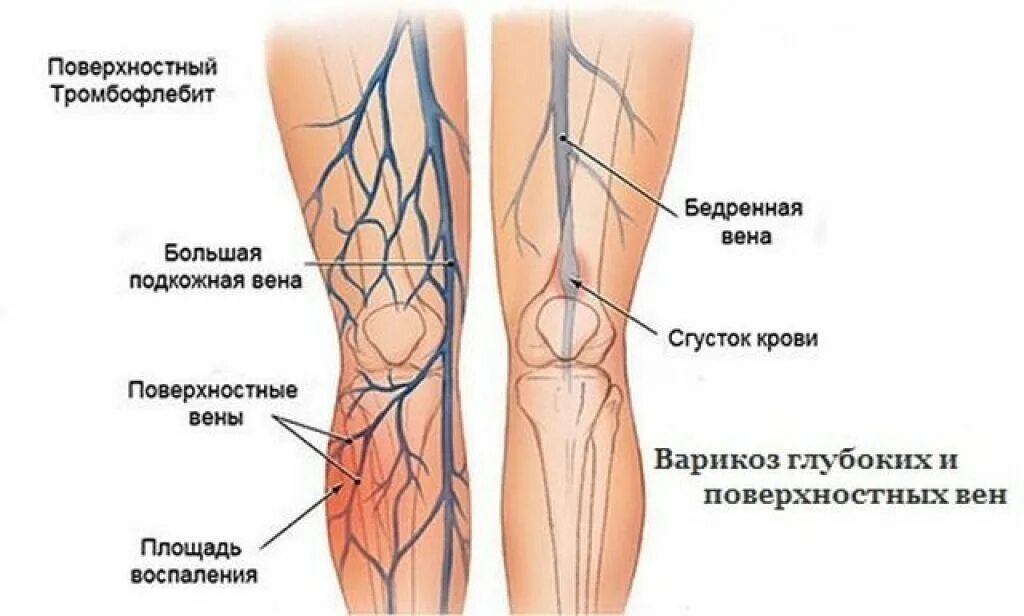 Что значат вены на ногах. Варикозное расширение вен нижних конечностей, тромбофлебит. Тромбофлебит вены голени. Тромбофлебит поверхностных и глубоких вен. Тромбофлебит подкожных вен.