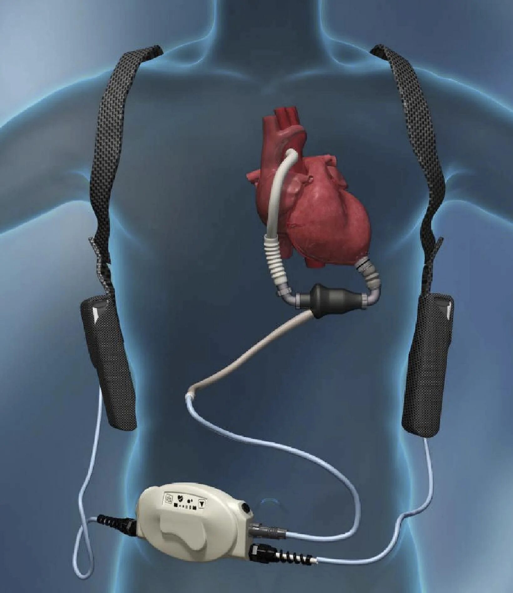 Что такое стимулятор. LVAD HEARTMATE 3. Система HEARTMATE III.